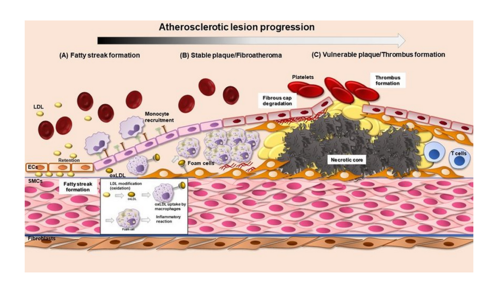 Atherosclerosis lesion progression